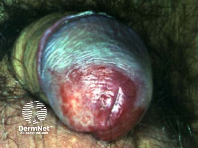 Plasma cell balanitis