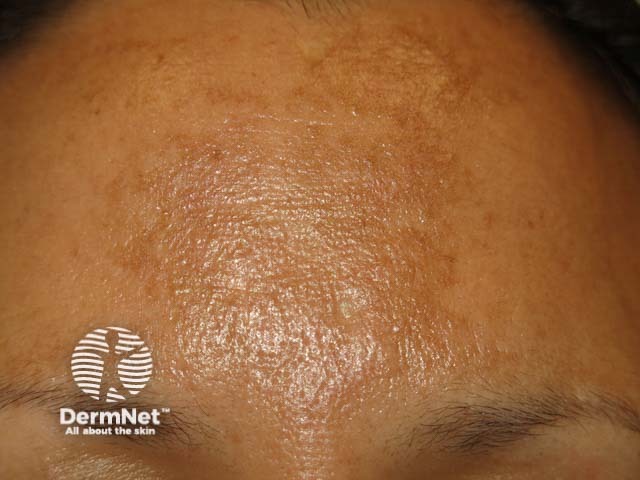 Melasma