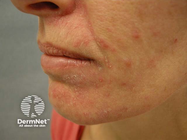 Perioral dermatitis