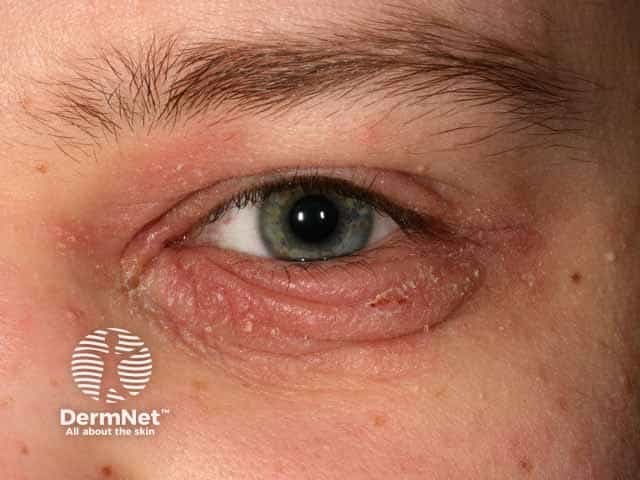 Atopic dermatitis