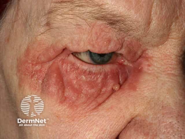 Seborrhoeic dermatitis