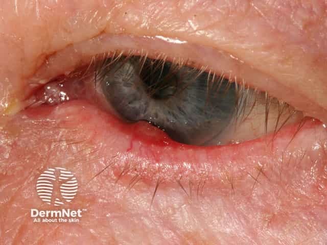 Chalazion