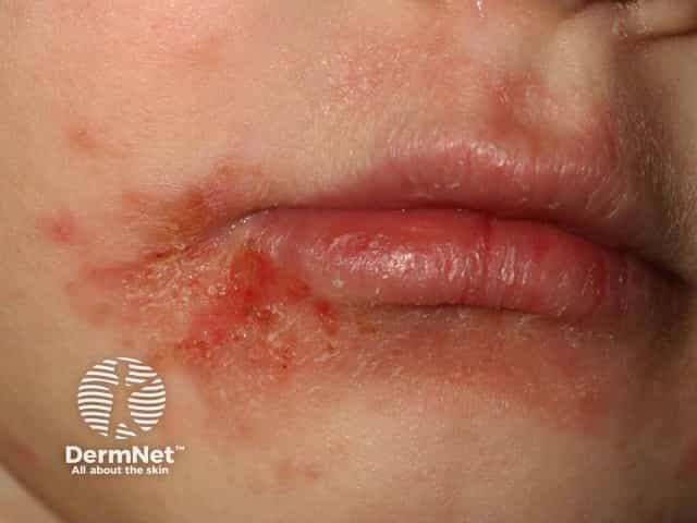 Atopic cheilitis