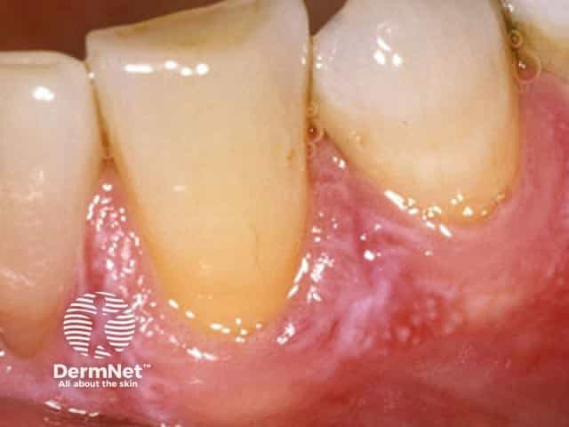 Erosive oral lichen planus