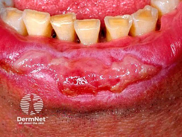 Erosive oral lichen planus