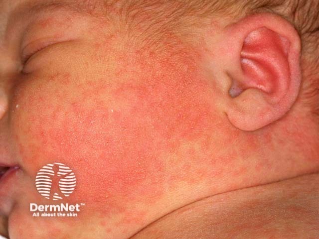 Toxic erythema of the newborn