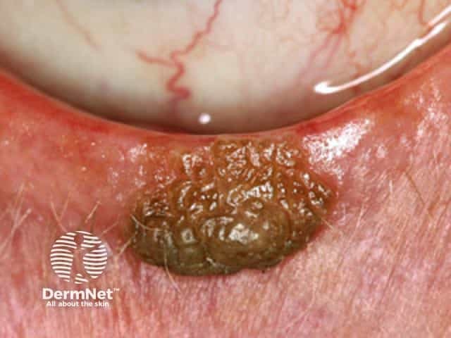 Seborrhoeic keratosis