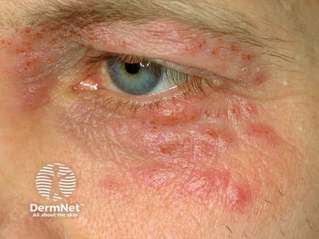 Herpes simplex