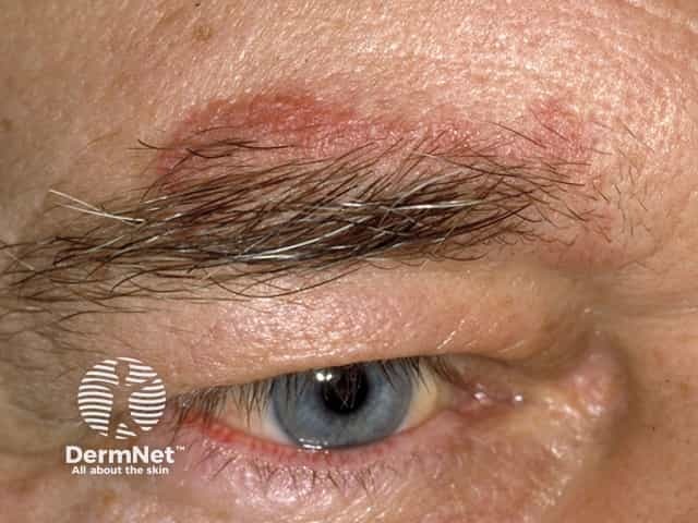 Seborrhoeic dermatitis