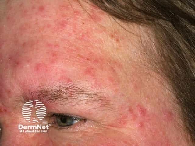 Rosacea