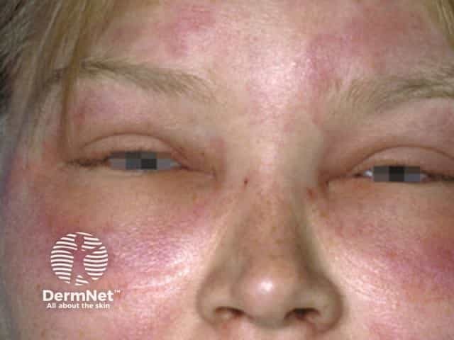 Angioedema