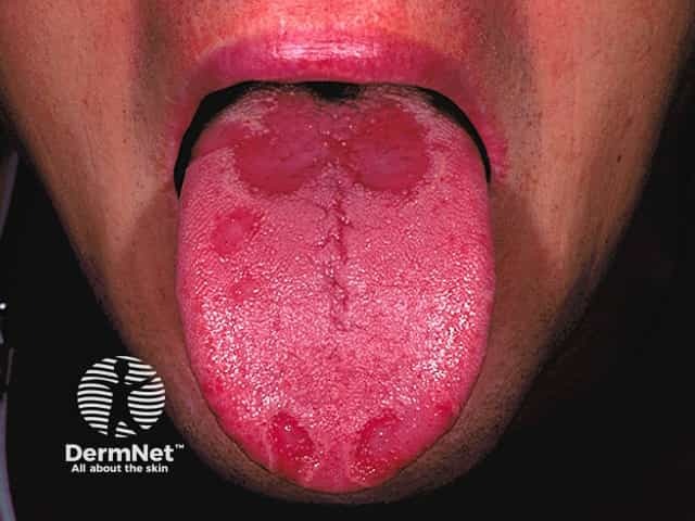 Geographic tongue