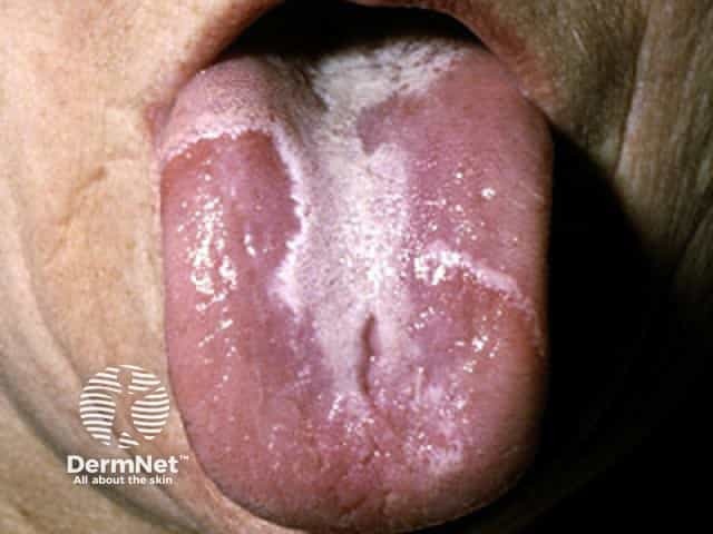 Geographic tongue