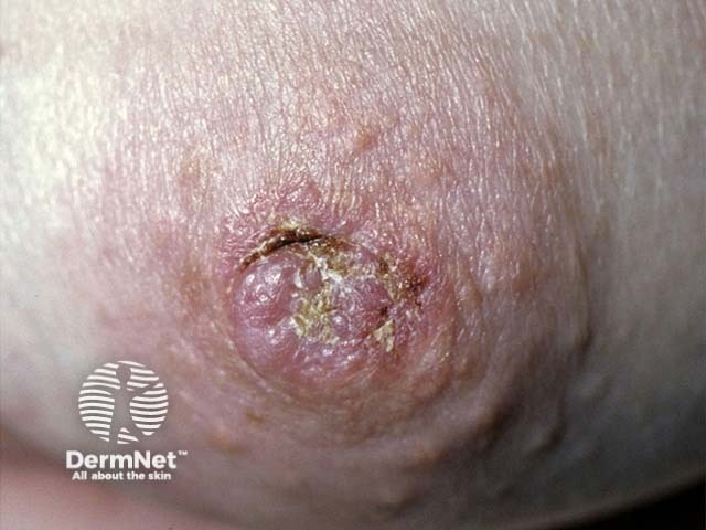 Mammary Paget disease of the skin