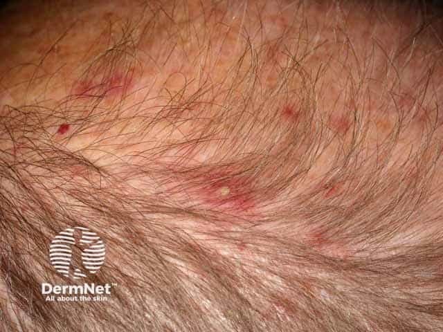 Scalp folliculitis