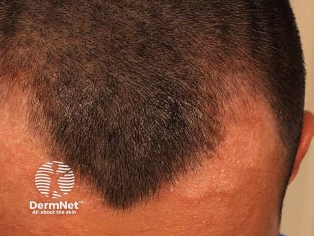 Seborrhoeic dermatitis