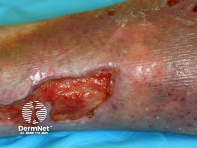 Venous ulcer