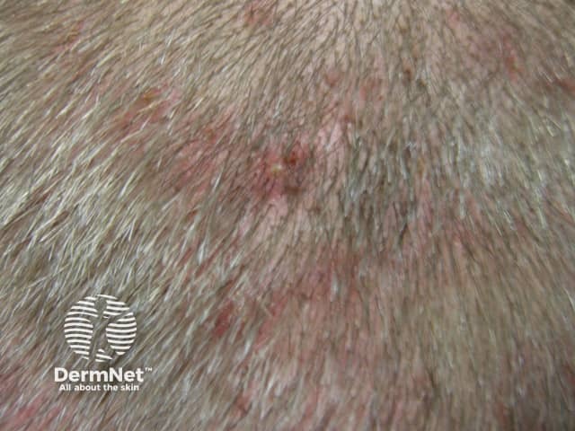 Scalp folliculitis