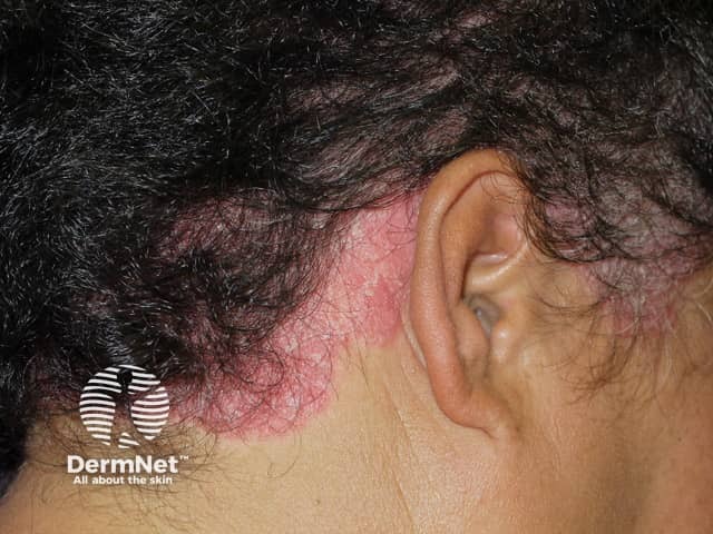 Scalp psoriasis