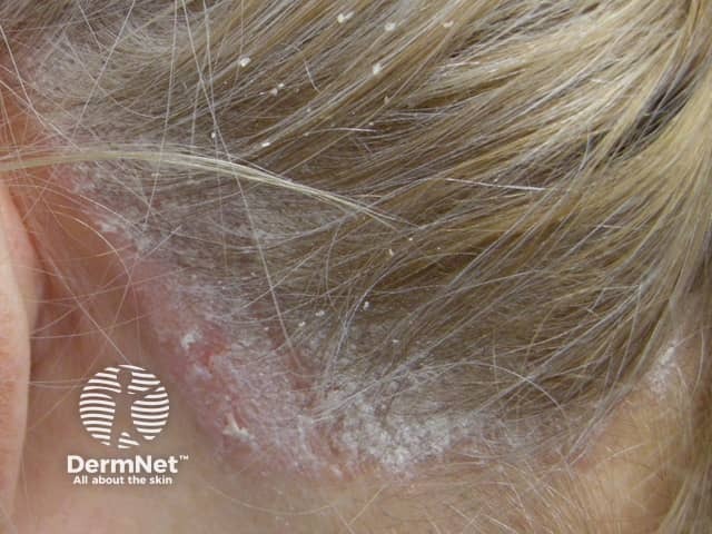 Scalp psoriasis