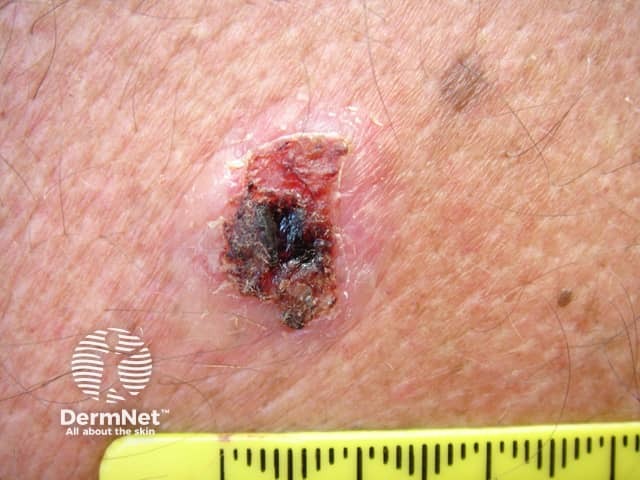 Basal cell carcinoma