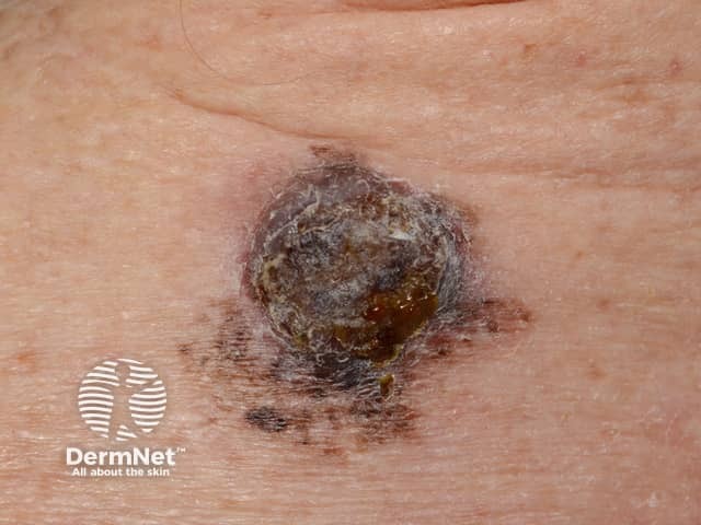 Ulcerated melanoma