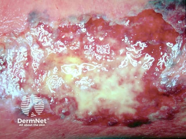 Pyoderma gangrenosum