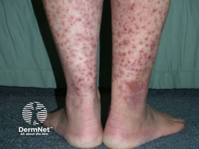 Small vessel vasculitis