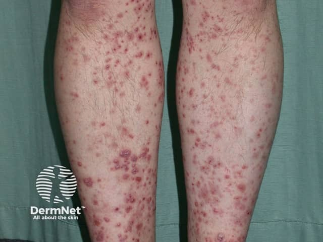 Small vessel vasculitis