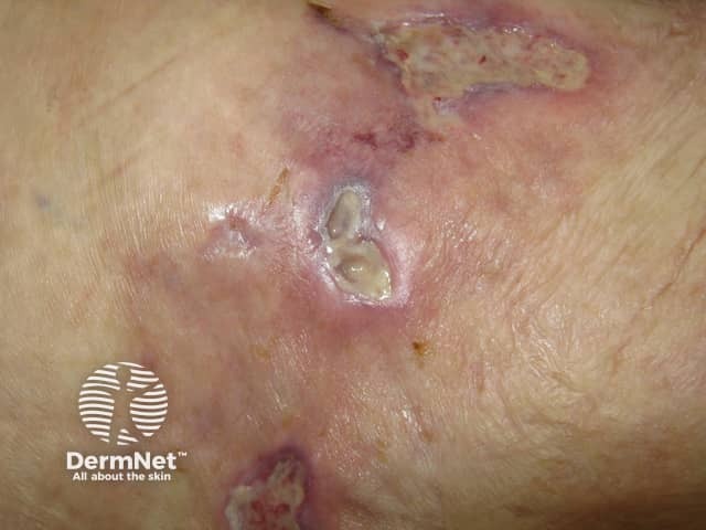 Calciphylaxis