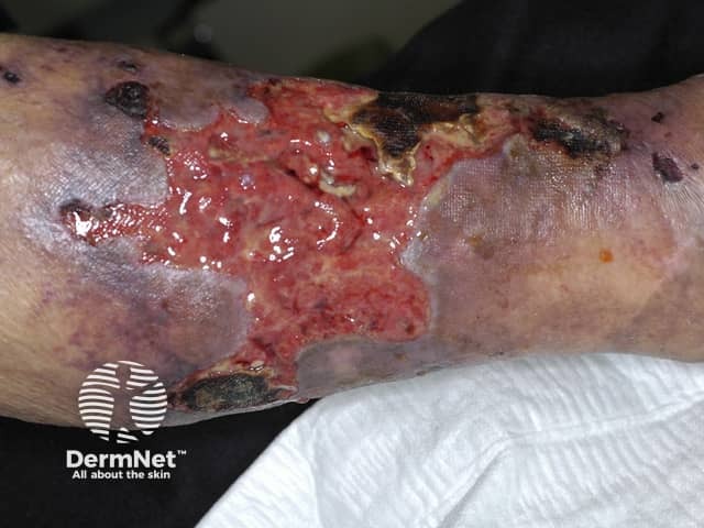 Calciphylaxis