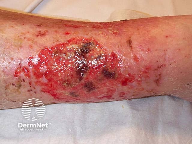 Venous ulcer