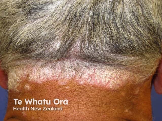 Scalp psoriasis