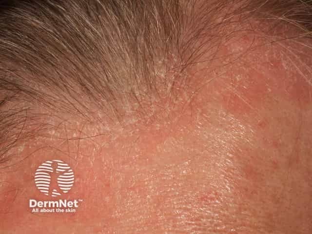 Seborrhoeic dermatitis