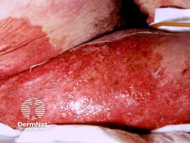 Toxic epidermal necrolysis