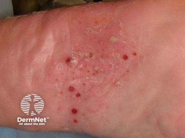 Plantar pustulosis