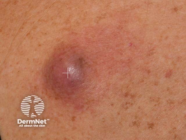 Spindle cell melanoma