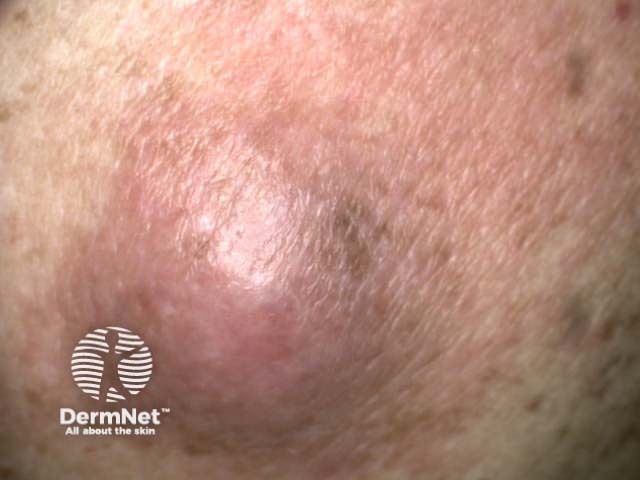 Spindle cell melanoma