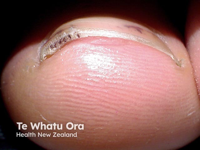 Splinter haemorrhages seen end on