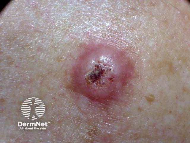 Squamous cell carcinoma