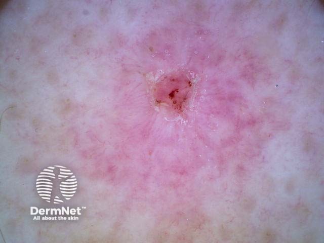 Squamous cell carcinoma nonpolarised dermoscopy view