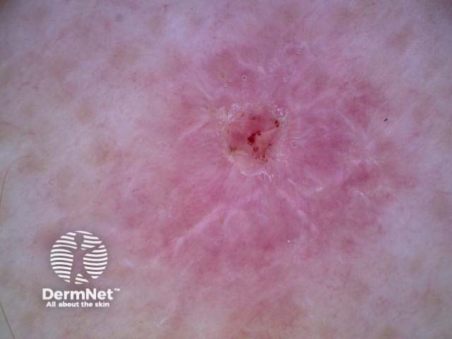 Squamous cell carcinoma polarised dermoscopy view