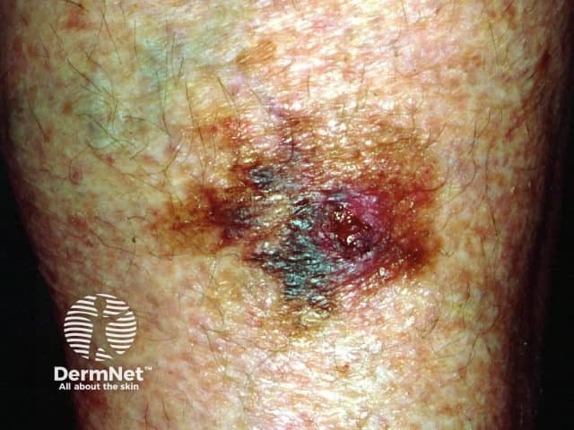 Superficial spreading melanoma