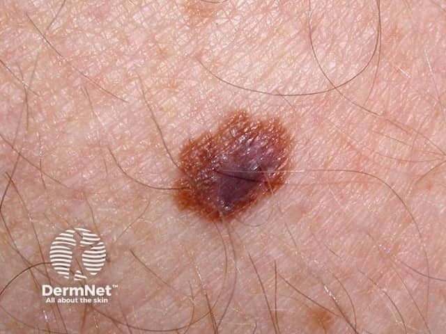 Macro image of superficial spreading melanoma 9