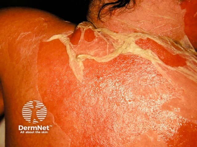 Staphylococcal scalded skin syndrome