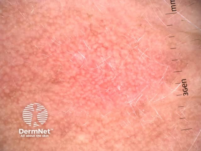 Strawberry pattern dermoscopy of facial actinic keratosis