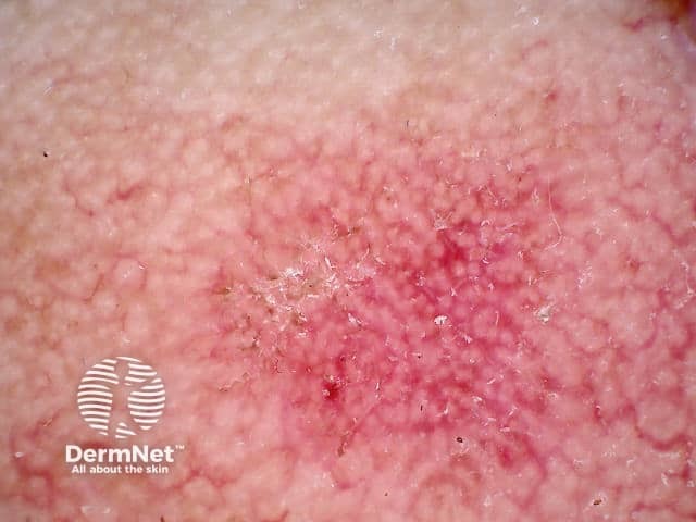 Strawberry pattern dermoscopy of facial actinic keratosis