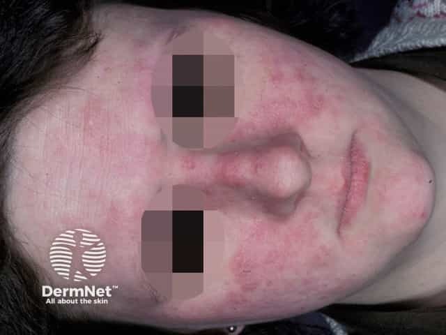 Subacute lupus erythematosus