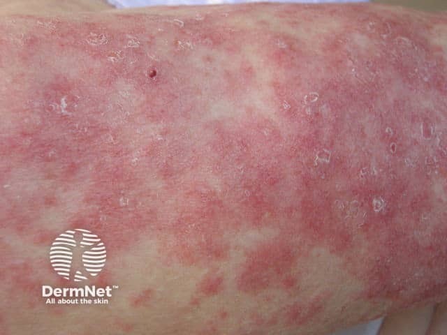 Subacute lupus erythematosus