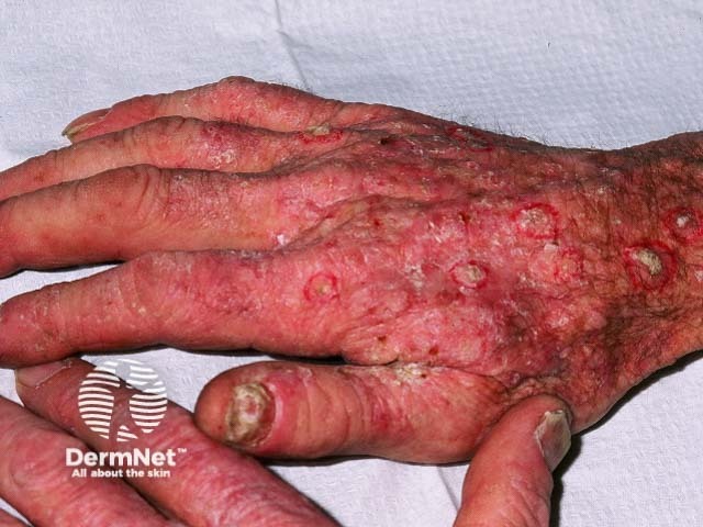 Actinic keratoses